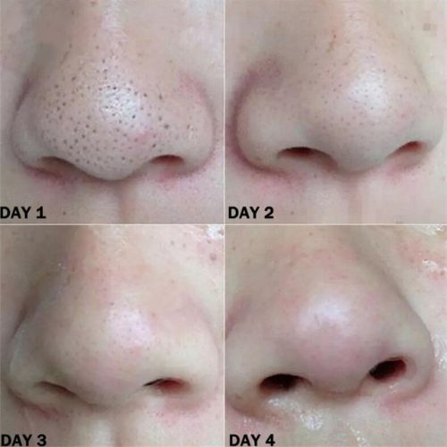 25x Nose Blackhead Remover Strips خمسة وعشرون شريحة لإزالة الرؤوس السوداء من الأنف